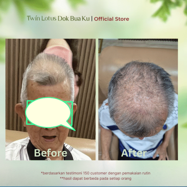 atasi rambut rontok