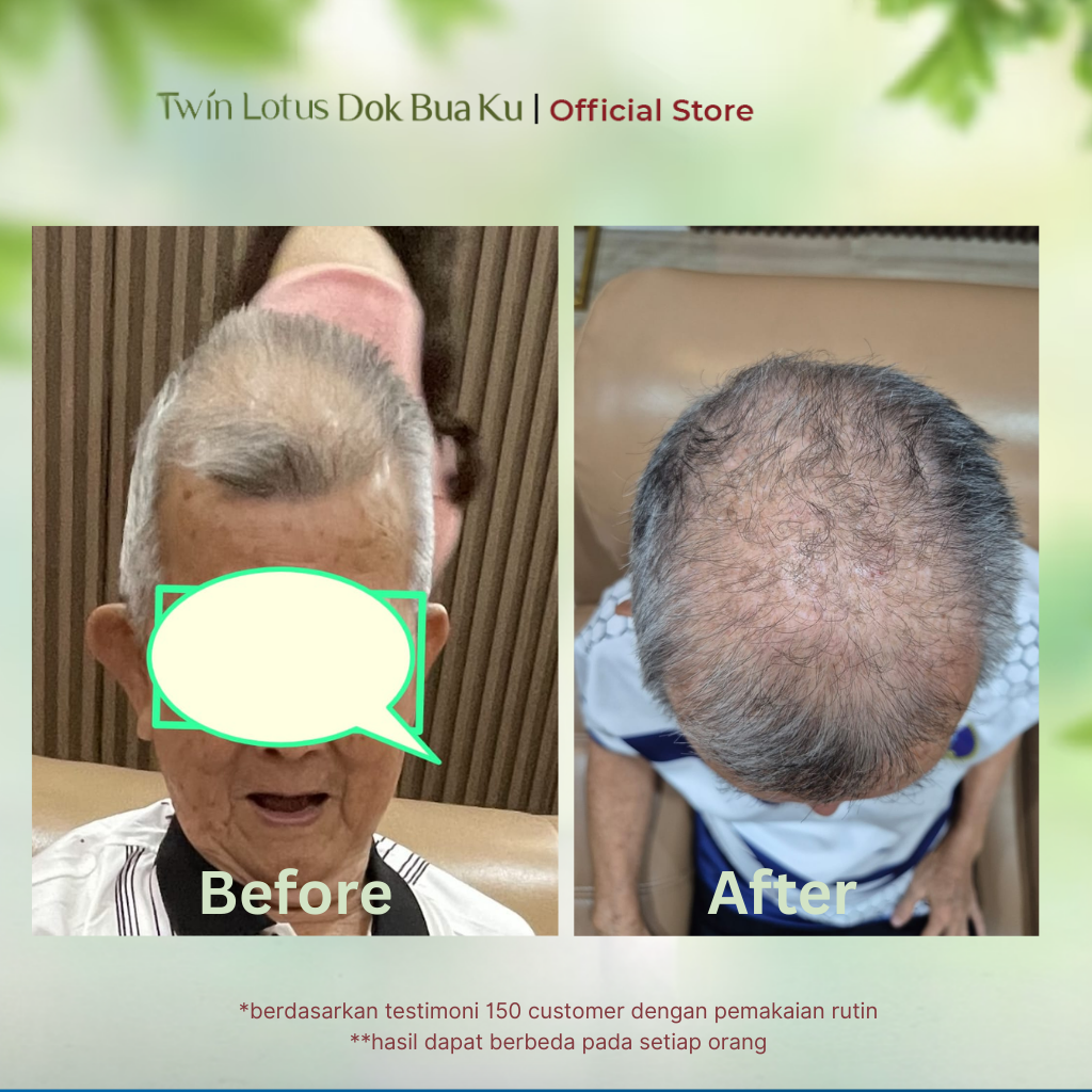 atasi rambut rontok
